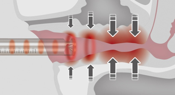 레이저질타이트닝 - 로앤산부인과