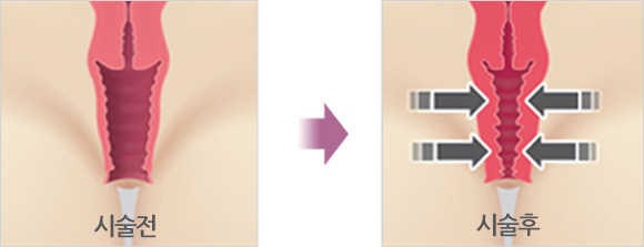 레이저질타이트닝 - 로앤산부인과